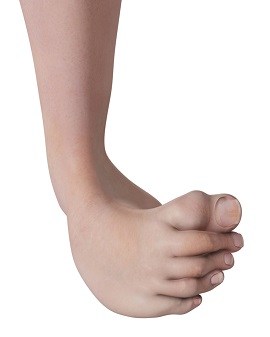 Congenital Deformity and Clubfoot