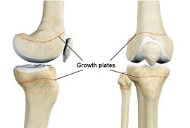 Growth Plate Fracture