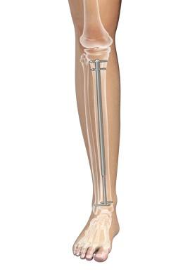 Intramedullary Nailing (Including Flexible Nailing of Pediatric Fractures)