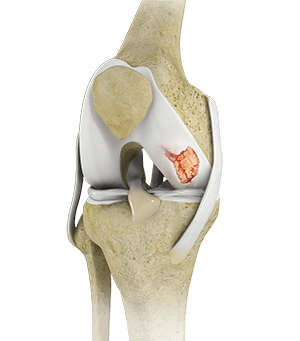 Knee Cartilage Restoration