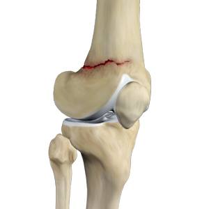 Knee fracture