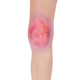 Septic arthritis