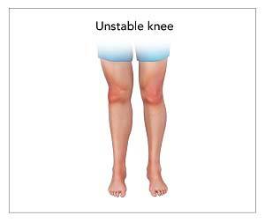 Unstable Knee