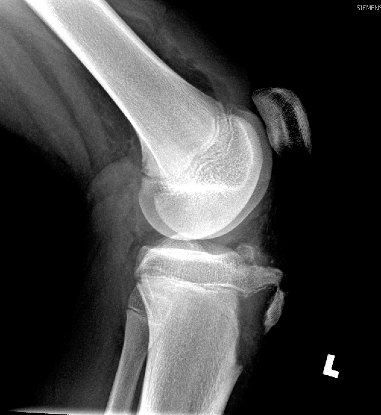 Tibia fractures