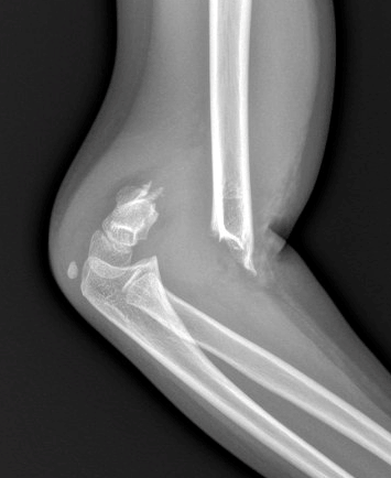 Elbow fractures
