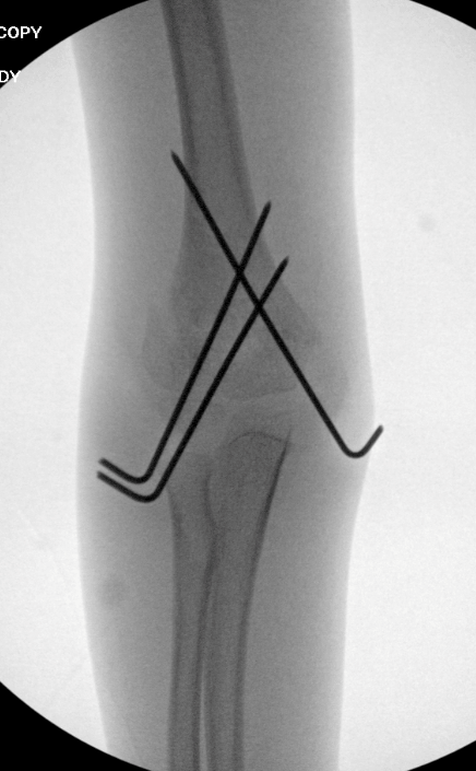 Elbow fractures