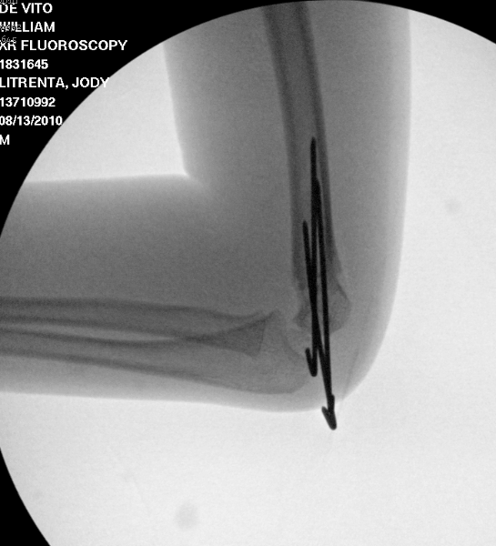 Elbow fractures