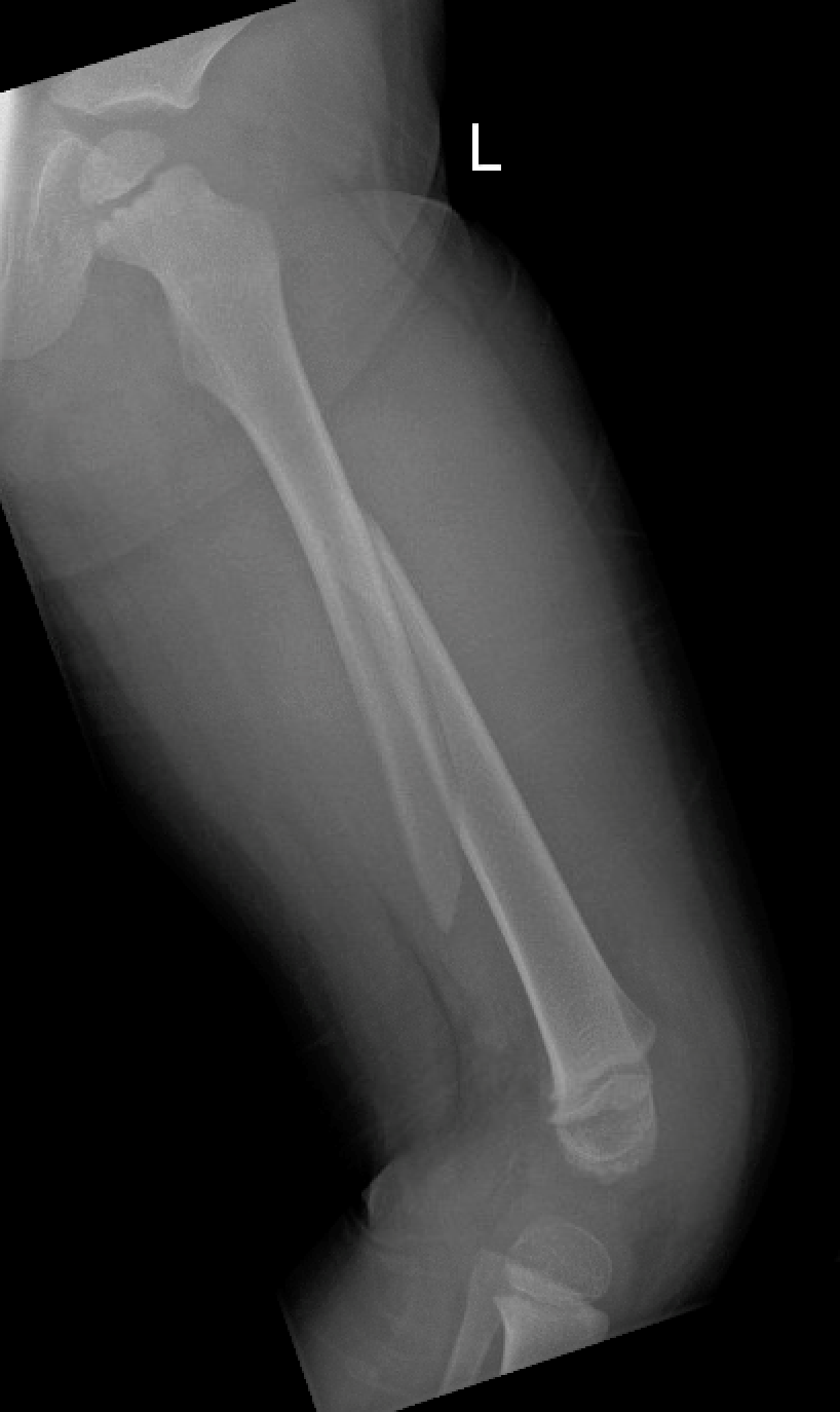 Femur fractures