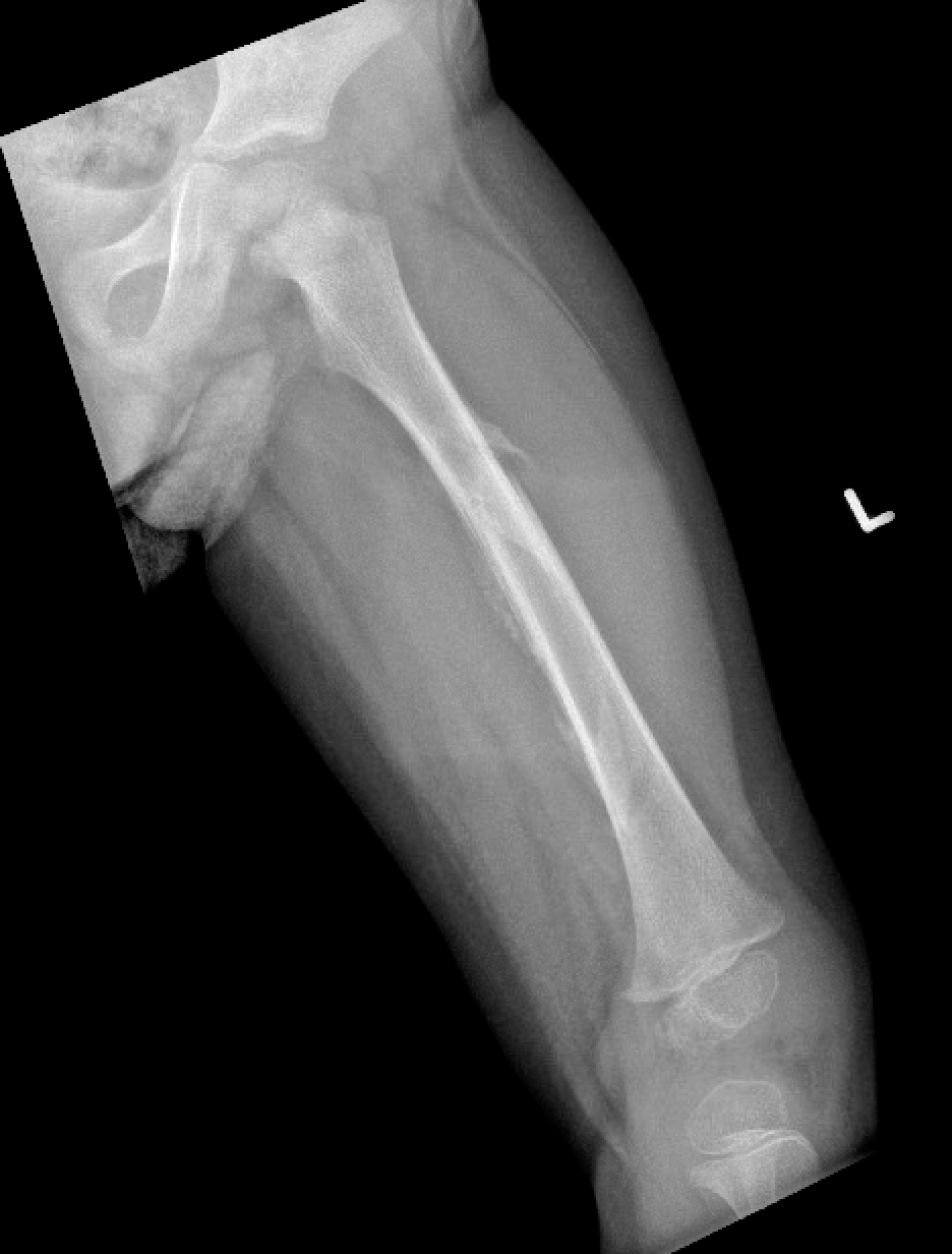 Femur fractures