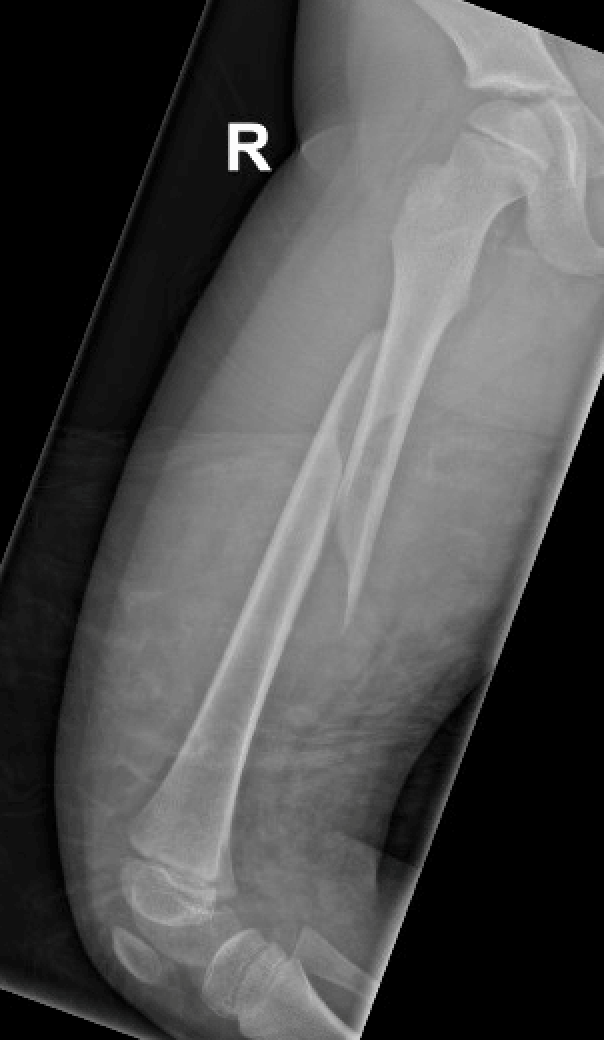 Femur fractures
