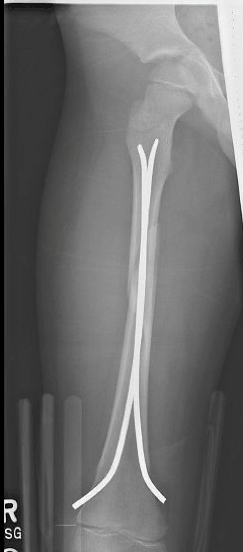 Femur fractures