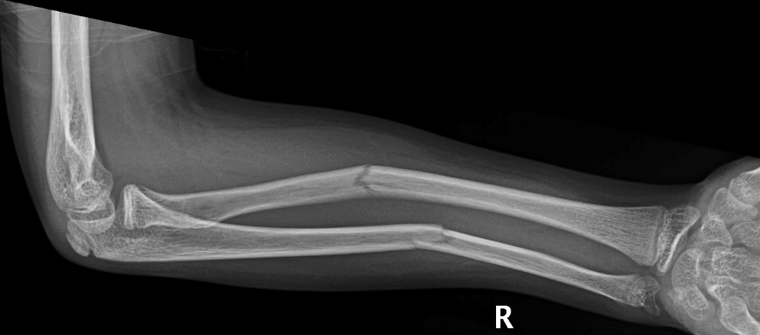 Forearm fractures
