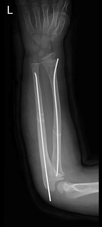 Forearm fractures