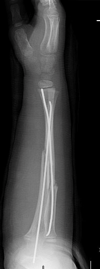 Forearm fractures