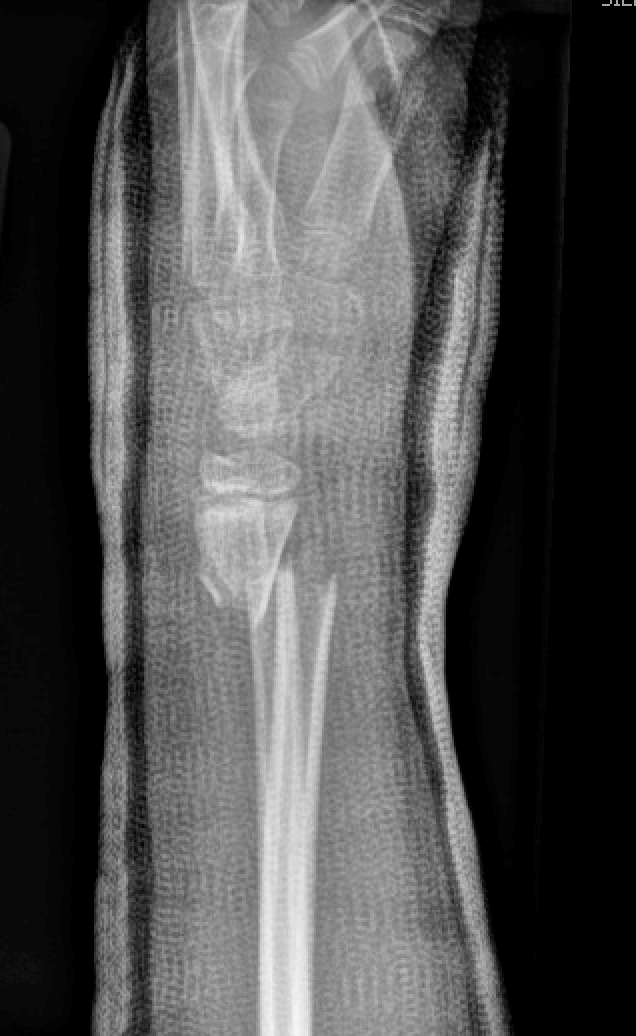 Forearm fractures