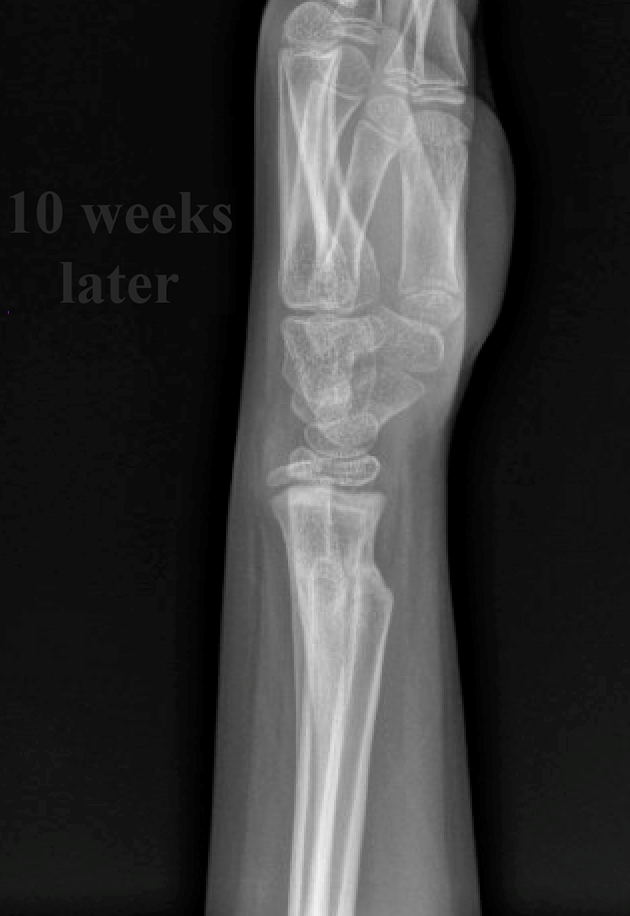 Forearm fractures