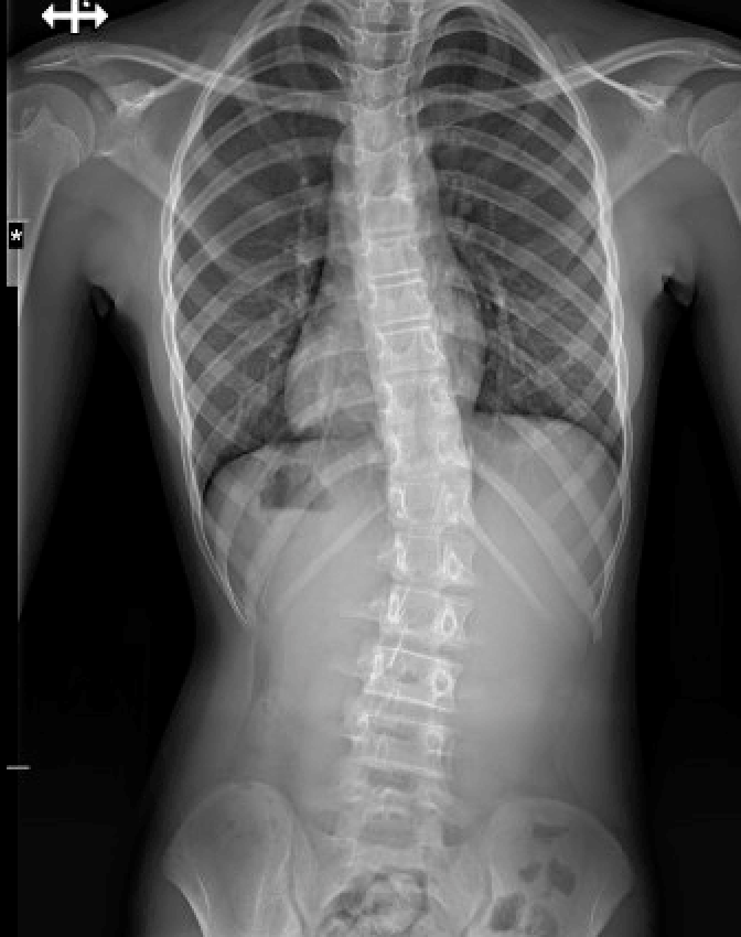 Scoliosis