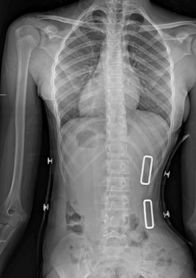 Scoliosis