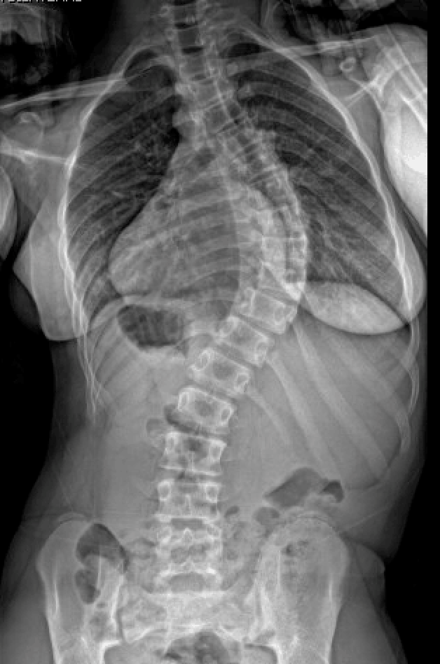 Scoliosis