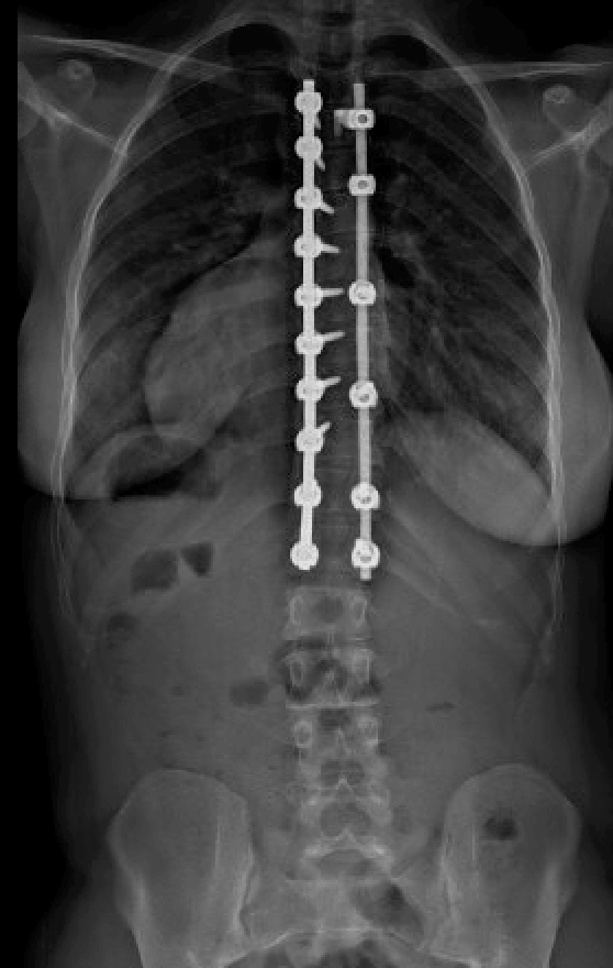 Scoliosis