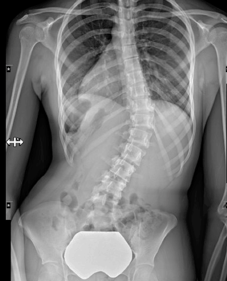 Scoliosis