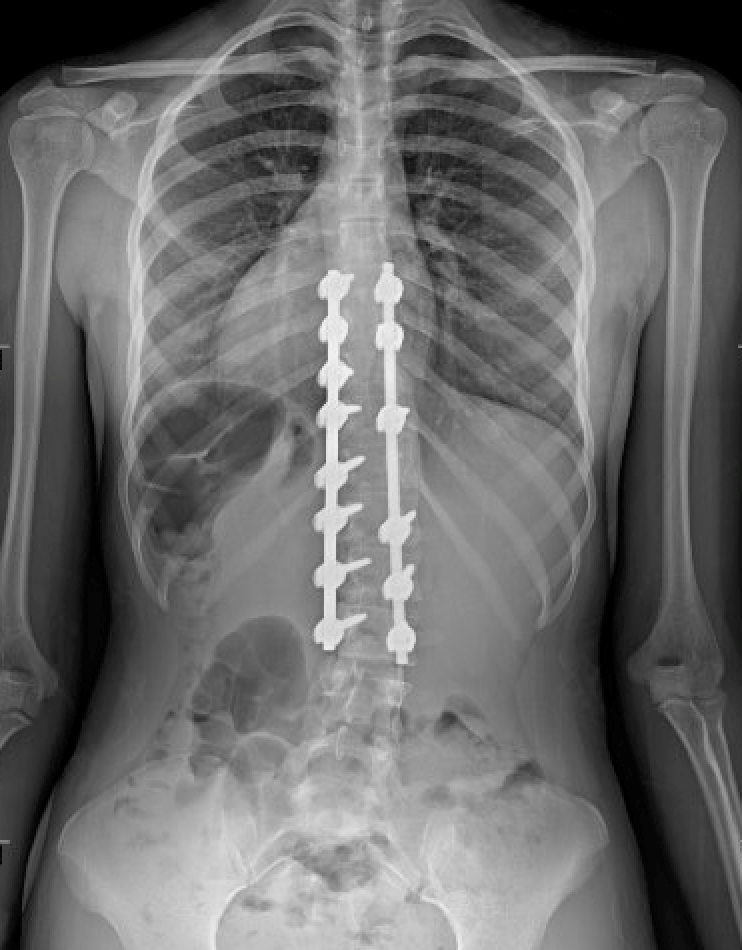 Scoliosis