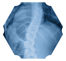 Scoliosis