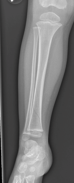 Tibia fractures