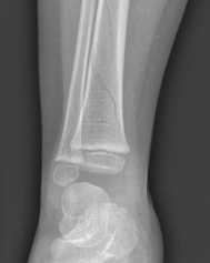 Tibia fractures