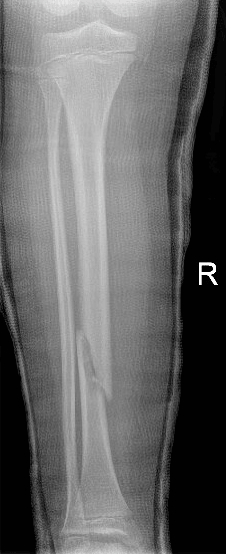 Tibia fractures