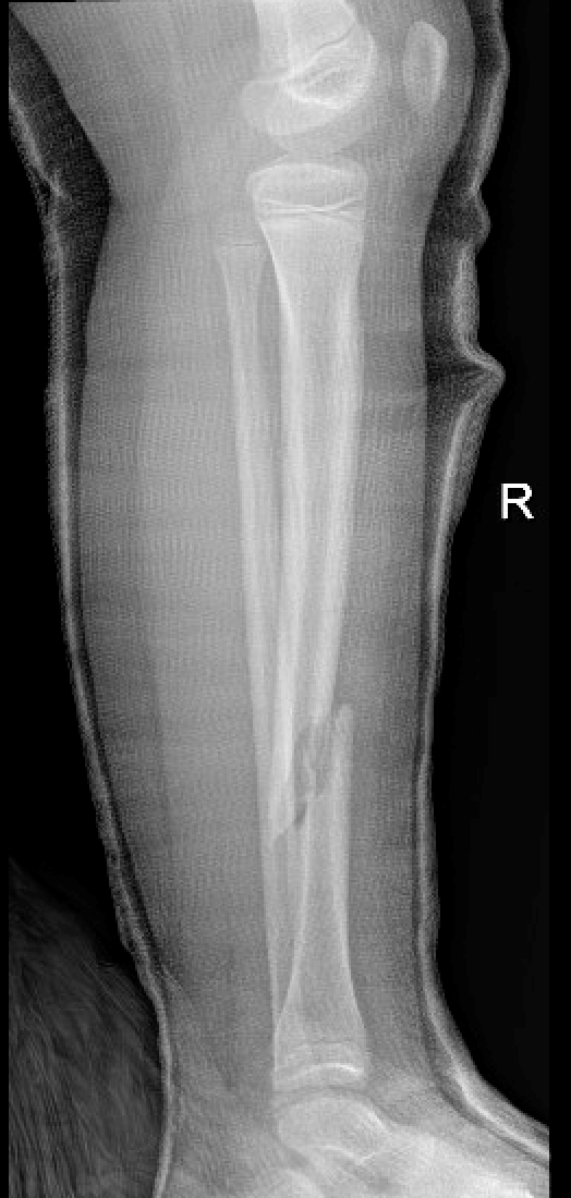 Tibia fractures