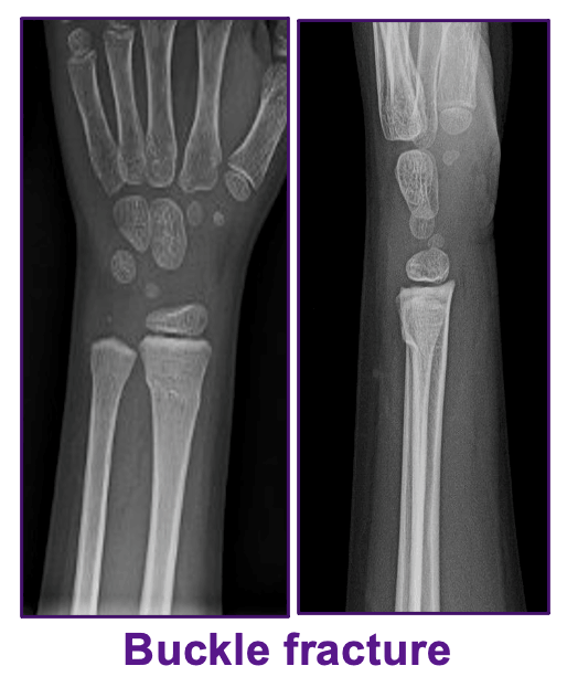 Wrist Fractures & Sprains